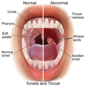 Tonsil Removal Surgery