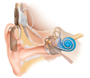 Cochlear Implant