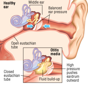 Inner Ear Infection